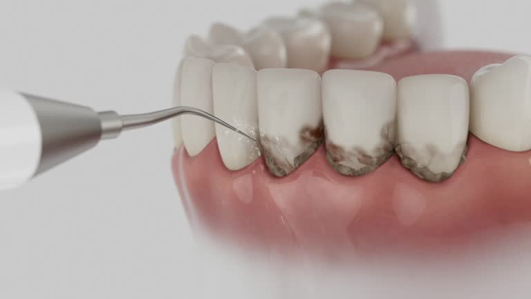 Trusted Wisdom Tooth Removal service in Rancho Cordova, CA - Dentist Open Now